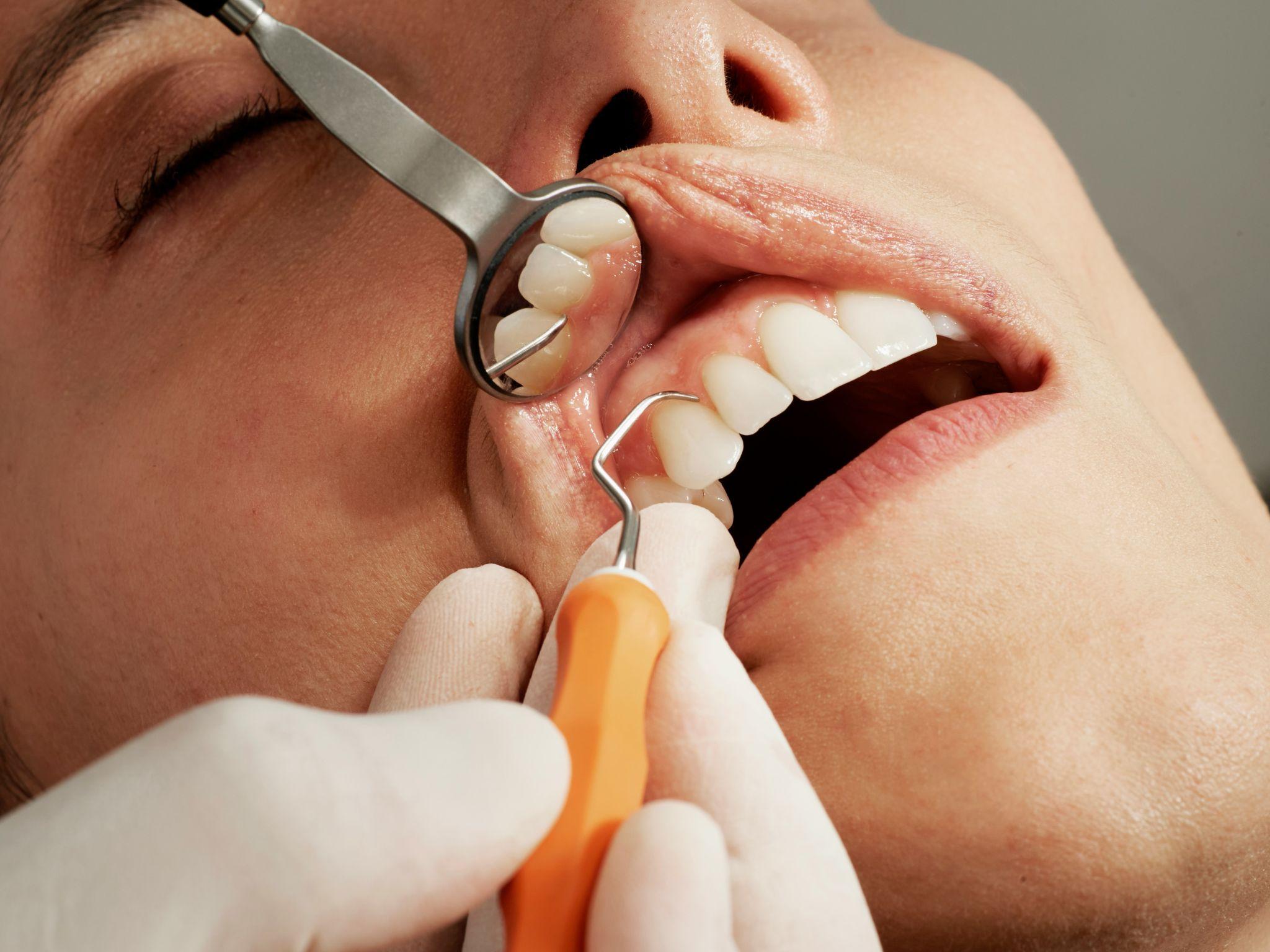 A close-up dental examination showing careful work related to dental restoration redesign in California.