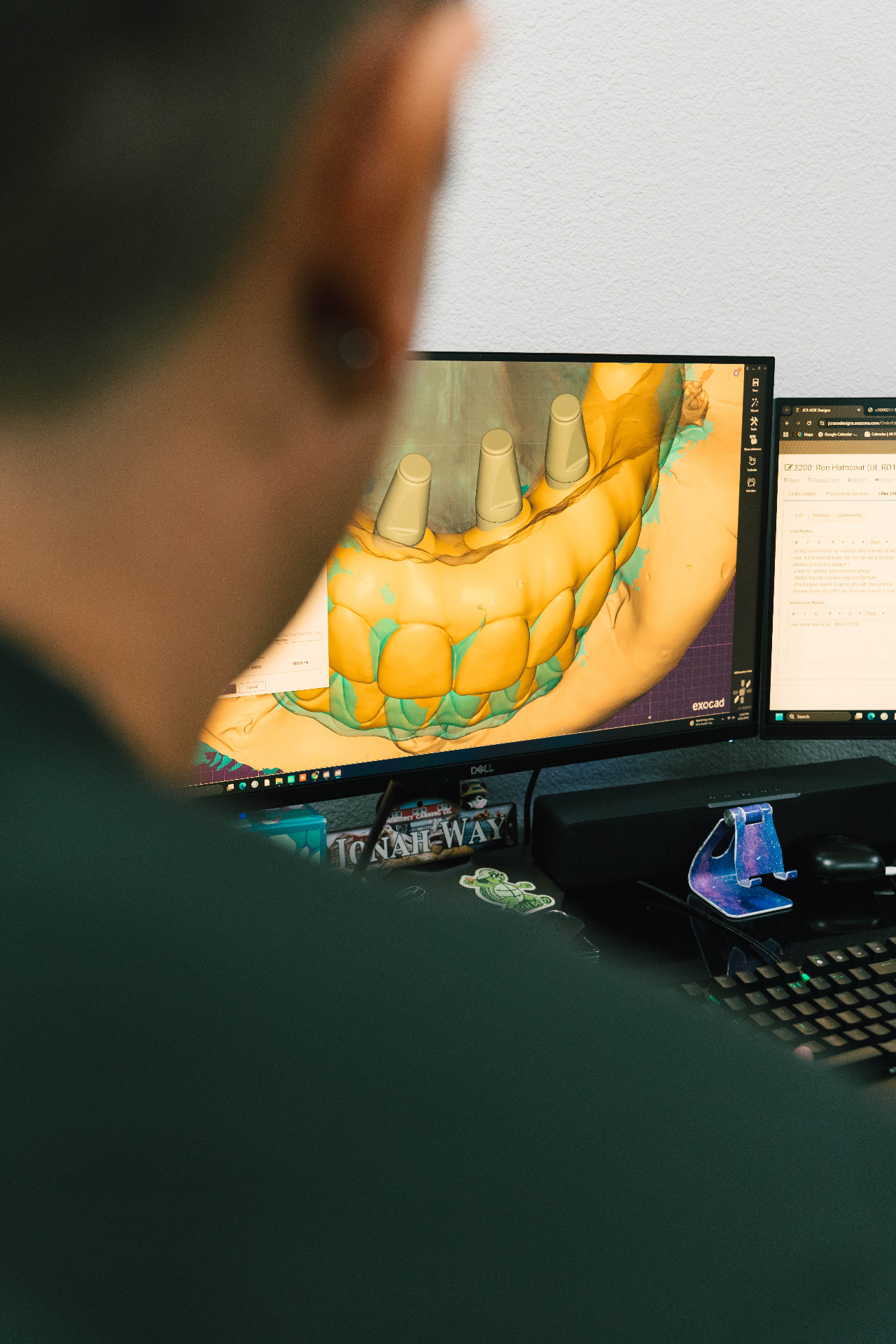 Designer crafting a digital full-arch case in exocad