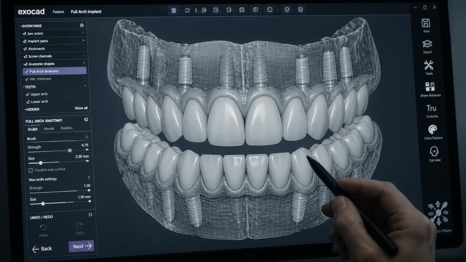 Digital dental lab CAD software designing a full-arch implant restoration for a California dental practice