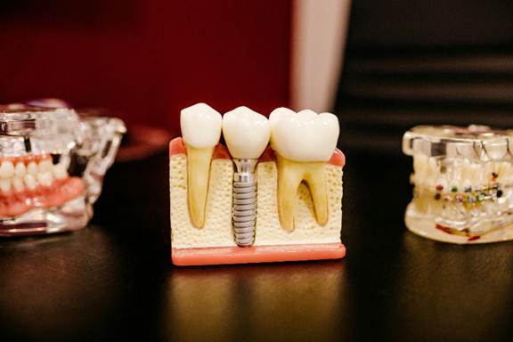 Custom dental prosthesis in California displayed as a dental implant and crown model