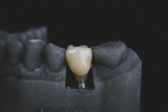 Dental prosthesis fabrication in California showing a custom dental crown model